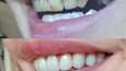 Tiinan hampaat kokivat alkuvuodesta melkoisen muutoksen.
