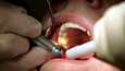 Monet hammaslääkäripeloista ovat turhia.