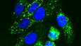 Syöpäsoluja, joissa MYC-geeni toimii aktiivisesti. Solujen tumat on leimattu sinisellä. 