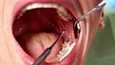 Jos hampaita ei ole vuosiin hoitanut kunnolla, on tehopesu ennen lääkäriaikaa yhtä tyhjän kanssa. 