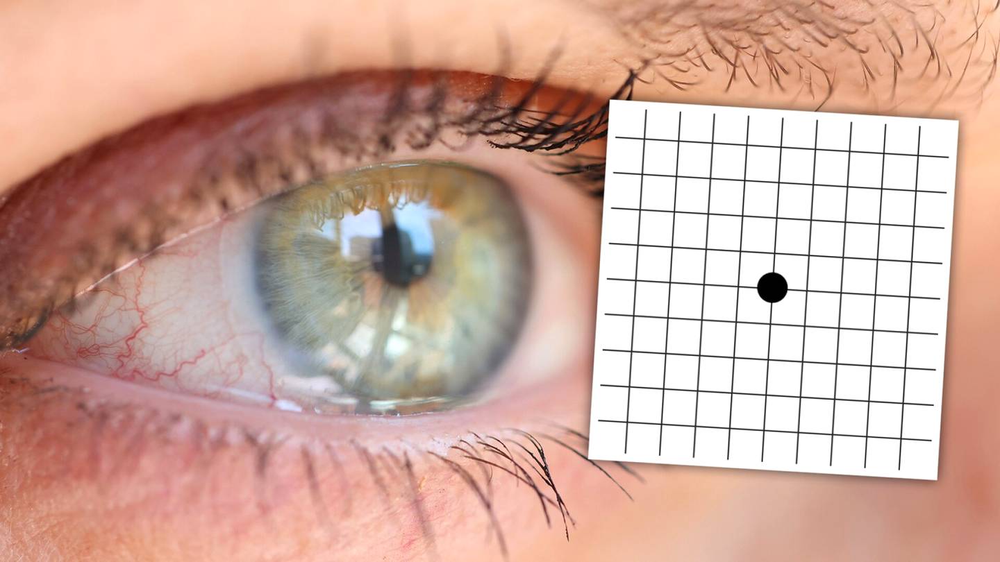 Tämä testi voi paljastaa silmä­sairauden – katso vain kuvaa