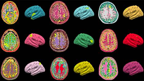 Kuvassa epilepsiaa sairastavien lasten ja aikuisten aivokuvia eri puolilta maailmaa. Tekoälyalgoritmin tunnistamat aivomuutokset näkyvät vaalean limenvihreinä.
