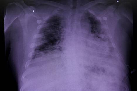Koronaviruksen aiheuttama covid-19-tauti voi jättää keuhkoihin pitkäaikaisia vaurioita.
