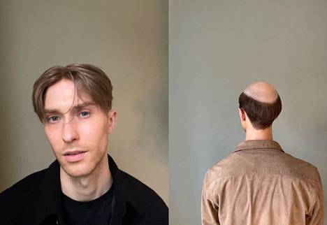 Juha Seppänen's hair began to thin at the age of 18.  Now she wears a vagina every day, which is shown in the picture on the left.