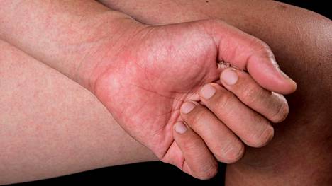 Koronatartunnan saaneilla ihmisillä on havaittu erilaisia iho-oireita.