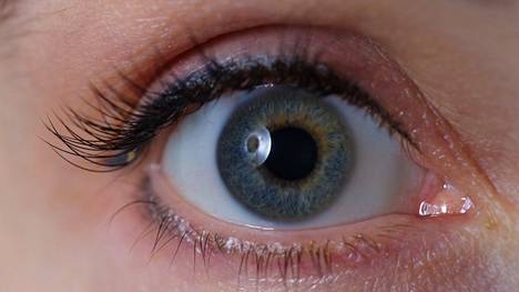 Näön hämärtyminen toisessa silmässä on yksi tyypillisimmistä MS-taudin oireista.