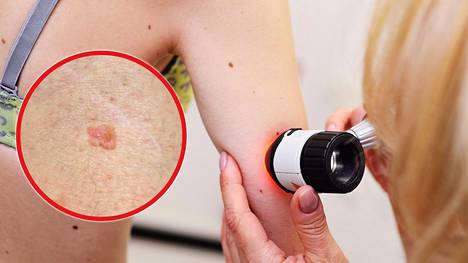 Okasolusyöpä on melanoomaa tavallisempi ihosyöpä. Suomessa todetaan vuosittain uusia okasolusyöpätapauksia noin 1700.