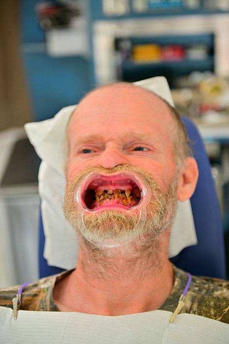 Tosi-tv-tähti Sugar Bear Thompsonin hampaat olivat järkyttävässä kunnossa.