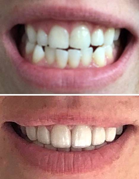 Yllä Elinan omat hampaat ennen laminaattiprojektin aloittamista. Alla hampaat nykyisessä tilassaan ylähampaisiin tehtyjen uusien laminaattien kanssa. Alahampaiden laminaatit odottavat vielä uusimista.