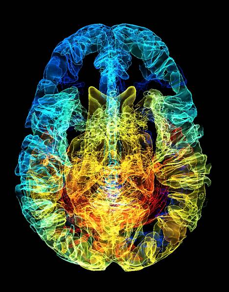 Väritetty 3D-magneettiresonanssikuva ihmisen aivoista. 