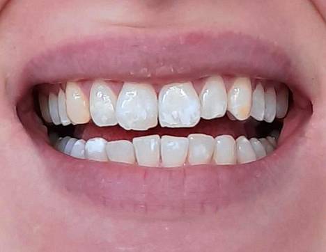 Seitsemän päivän kotivalkaisu on takana. Hampaat ovat jo nyt huomattavasti valkoisemmat, mutta myös kiillelaikut ovat korostuneet. Kulmahampaiden keltaisuus pistää yhä enemmän silmään. Edestäpäin katsottuna vasemman kulmahampaan alaosassa on kymmenisen vuotta vanha muovikerros.