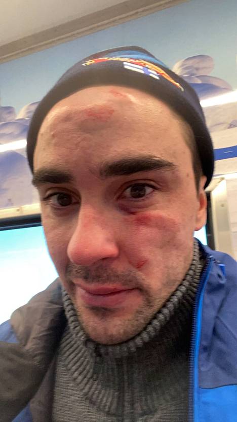Rukan maailmancupissa vauhdilla puuhun laskeneelta Hakolalta murtui kaksi kylkiluuta, mutta myös hänen kasvonsa ”komistuivat” uusilla piirteillä.