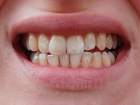 Hampaat kesällä luonnonvalossa puhelimella kuvattuna. Arvelen kellastumisen olevan osittain luonnollista ja osittain esimerkiksi runsaan kahvinjuonnin aikaansaamaa. Kiillelaikkuja hampaissa on ollut niin kauan kuin muistan.