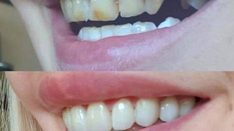 Tiinan hampaat kokivat alkuvuodesta melkoisen muutoksen.