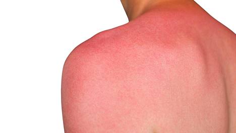 Ehditkö jo käräyttää ihosi auringossa? 4 mokaa, jotka vain pahentavat  tuskaasi - Terveys - Ilta-Sanomat