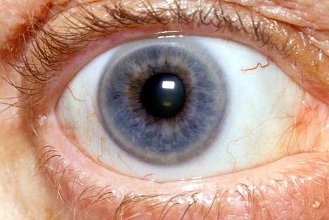 Silmään ilmestyvä harmaa rengas voi olla rasvaa, jos olet alle 40-vuotias. Tällöin se kielii vaarallisen korkeasta kolesterolista.