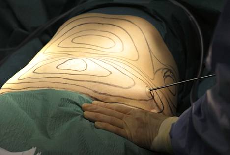 Husin plastiikkakirurgialla jouduttiin loppukeväästä linjaamaan, millaisissa tapauksissa kauneusturisteja voidaan hoitaa.