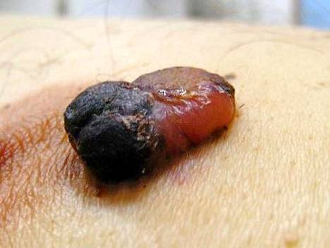 Nodulaarinen melanooma kasvaa tyypillisesti nopeasti paksuutta. Kuvan melanooman koko noin  1,5 cm.