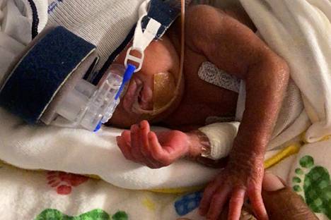Ennätyskeskonen kotiutui vasta yhdeksän kuukautta syntymänsä jälkeen sairaalasta.