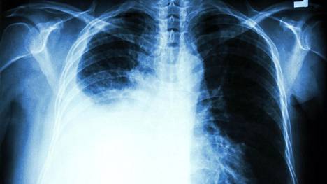 Keuhkosyöpä on yksi tappavimmista syövistä.