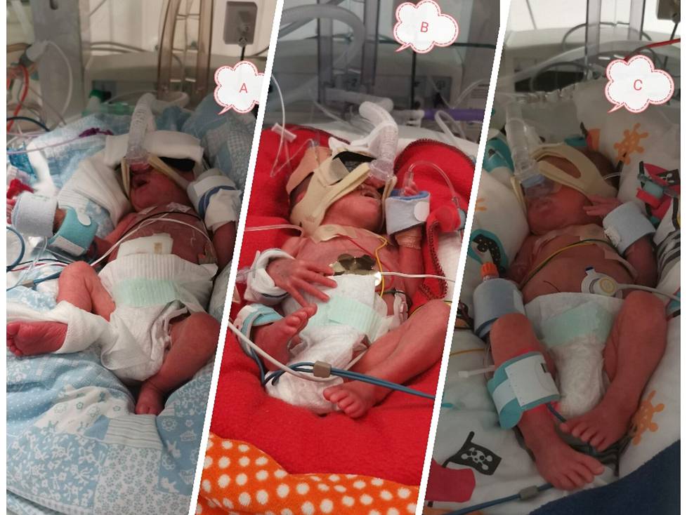 Kun kolmoset syntyivät, Jenna sai nähdä heidät pienen hetken ajan ennen kuin jokainen vietiin omaan keskoskaappiinsa ja sairaalahuoneeseensa. 