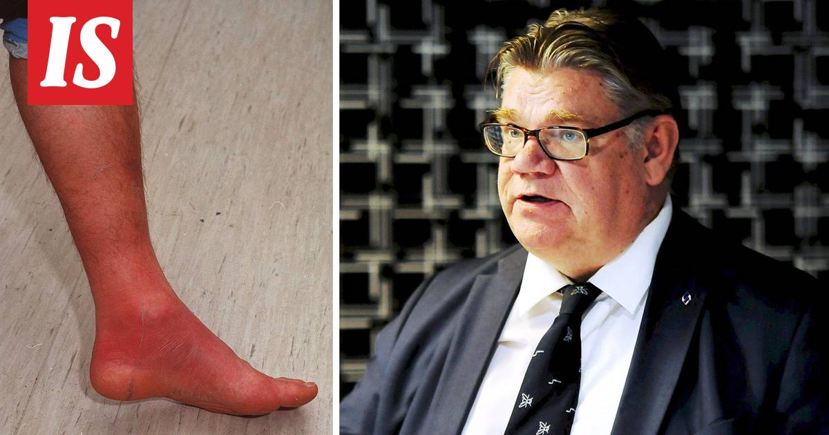 Timo Soini sai vakavan ruusun jalkaan – pään alueelle iskiessään infektio  voisi aiheuttaa hengenvaaran - Kotimaa - Ilta-Sanomat